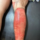 Mujer denunció que su pareja le derramó alcohol y le prendió fuego